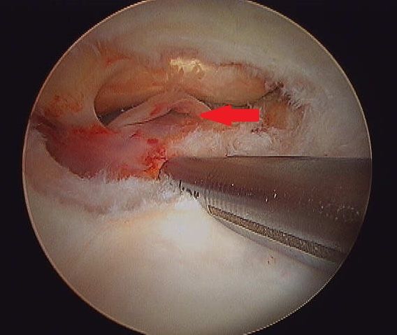 BEFORE Tear of deep digital flexor tendon in navicular bursa.