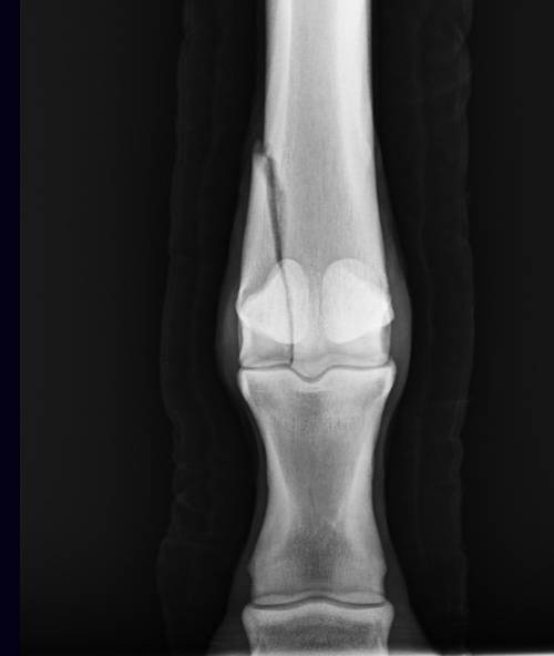 A condylar fracture is a repetitive strain injury that results in a fracture to the cannon bone above the fetlock due to large loads transmitted during high-speed exercise.
