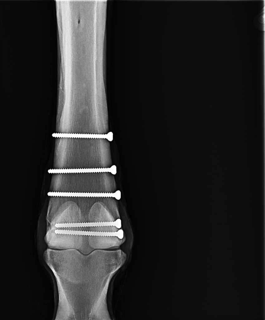 Digital radiographs show a condylar fracture to the right front leg, and the five screws that completed the surgery. 